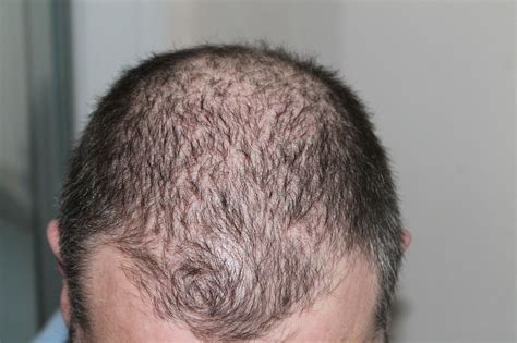 A small study of 50 people suffering with . . Scientist cure for baldness
